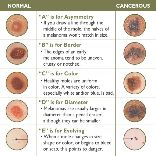skin cancer spots